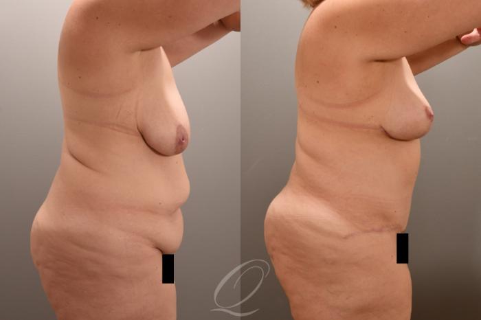 Mommy Makeover Case 1001723 Before & After Right Side | Serving Rochester, Syracuse & Buffalo, NY | Quatela Center for Plastic Surgery