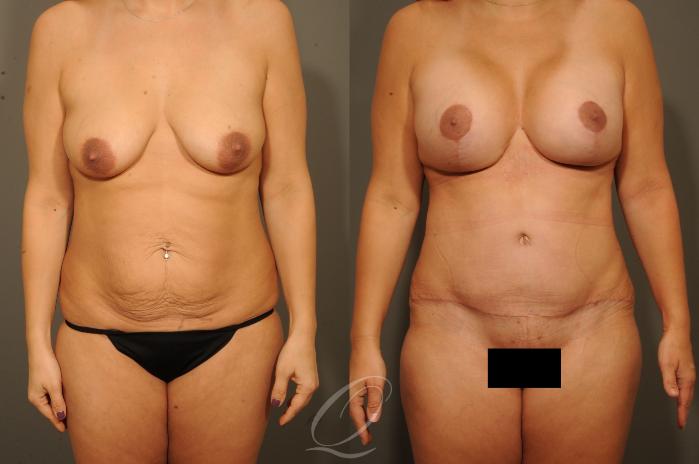 Mommy Makeover Case 1326 Before & After View #1 | Serving Rochester, Syracuse & Buffalo, NY | Quatela Center for Plastic Surgery